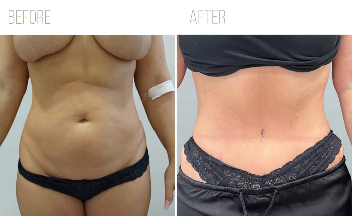 Before and after example
