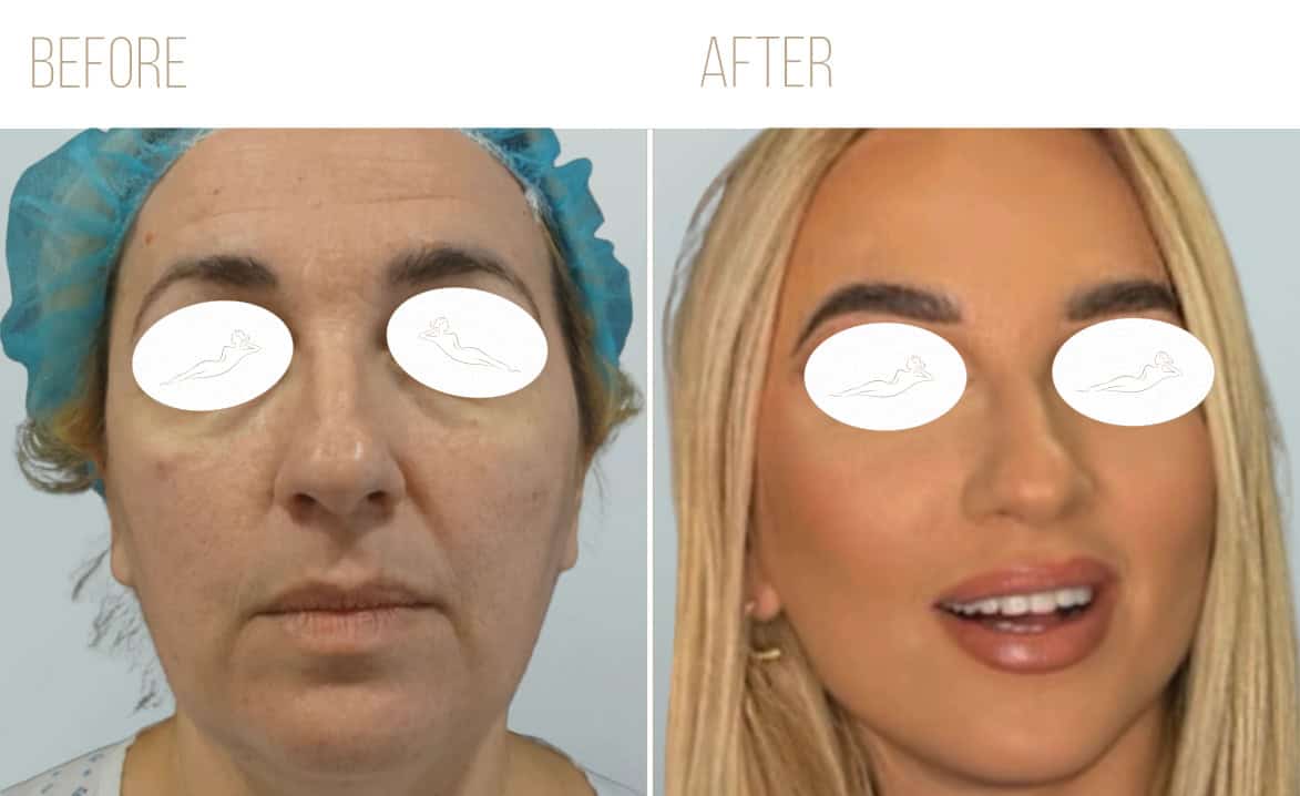 Before and after example
